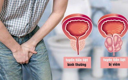 4 thói quen tăng nguy cơ gây ung thư tuyến tiền liệt, nam giới tuyệt đối không được bỏ qua