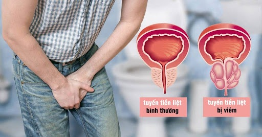 4 thói quen tăng nguy cơ gây ung thư tuyến tiền liệt, nam giới tuyệt đối không được bỏ qua - Ảnh 2.