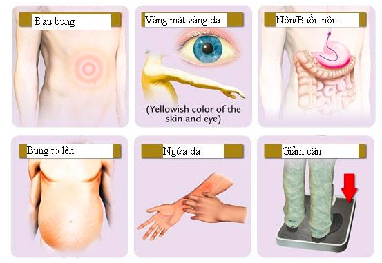 5 loại ung thư đàn ông Việt hay gặp nhất và những dấu hiệu cảnh báo - Ảnh 3.
