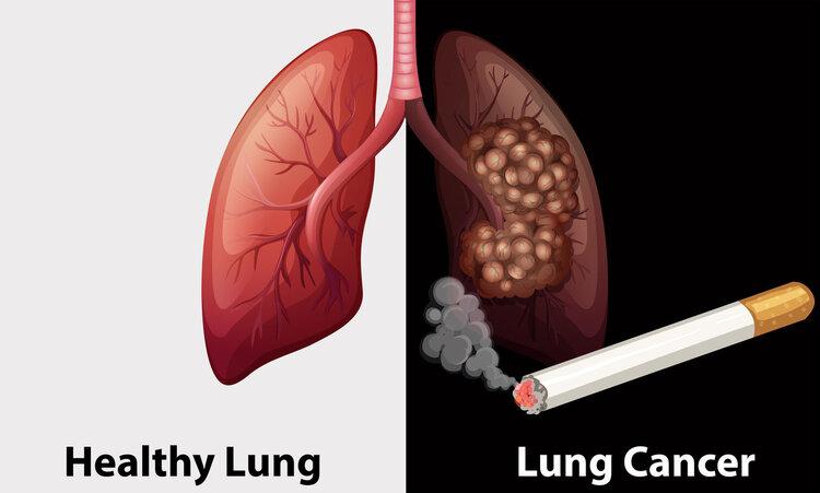 Nếu có 4 dấu hiệu bất thường ở đầu, hãy cảnh giác sự xuất hiện của ung thư phổi - Ảnh 2.