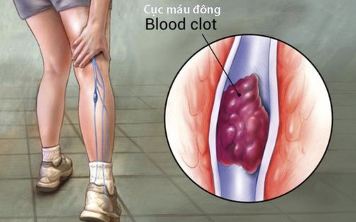 7 dấu hiệu cảnh báo có cục máu đông trong cơ thể, cần làm gì để loại bỏ căn bệnh nguy hiểm này