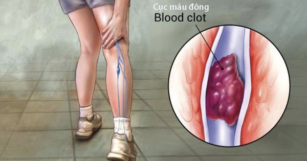 7 dấu hiệu cảnh báo có cục máu đông trong cơ thể, cần làm gì để loại bỏ căn bệnh nguy hiểm này - Ảnh 4.
