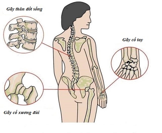 5 loại thực phẩm cần tránh khi bạn bị loãng xương - Ảnh 2.