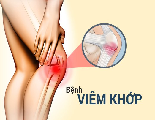 Người bệnh viêm khớp nên uống gì để giảm cơn đau khi trời lạnh? - Ảnh 2.