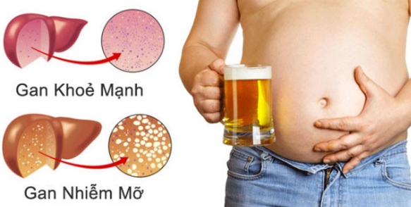 Những thực phẩm ăn khi uống rượu bia sẽ làm tăng nguy cơ ung thư gan, cần sớm thay đổi thói quen xấu này! - Ảnh 2.