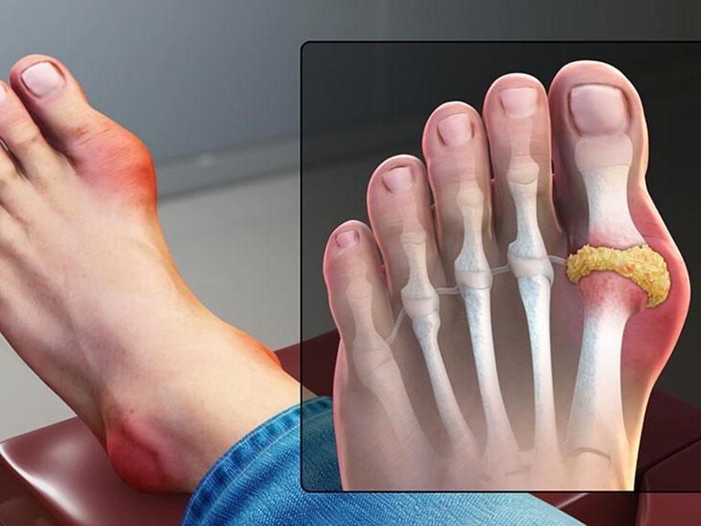 Sau Tết bệnh gout tái phát cần làm các điều sau để giảm đau - Ảnh 2.