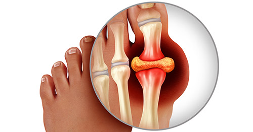 Nhận biết 5 tác nhân phổ biến gây ra cơn đau trong bệnh gout - Ảnh 1.