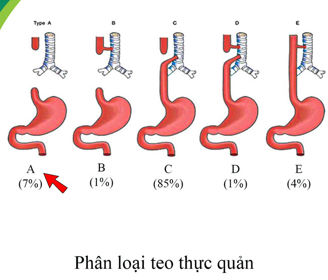 Phẫu thuật thành công &quot;tạo hình thực quản bằng đại tràng&quot; cho bé gái bị teo thực quản hiếm gặp - Ảnh 1.