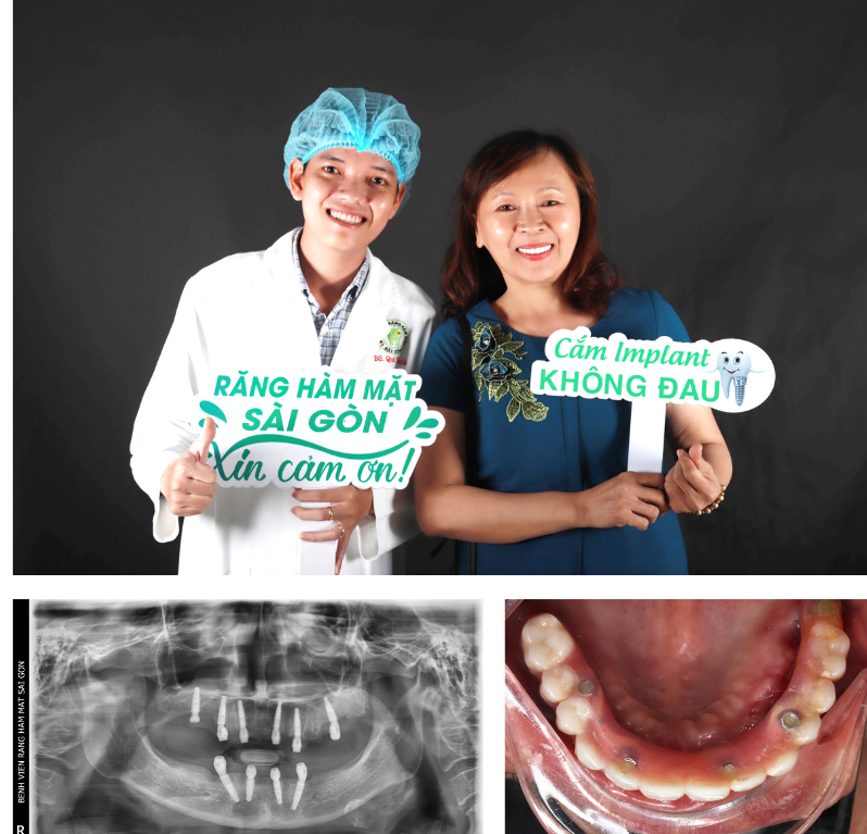 &quot;Tái sinh&quot; toàn hàm với phương pháp Implant All on 4 - Ảnh 2.