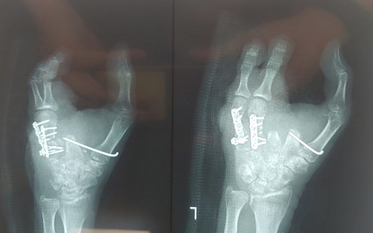 Kỳ diệu, bác sĩ 'biến' ngón chân thành ngón tay cho người bị dập nát tay do tai nạn máy xay thịt
