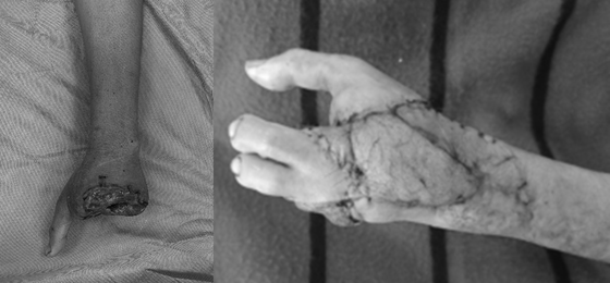 Kỳ diệu, bác sĩ &quot;biến&quot; ngón chân thành ngón tay cho người bị dập nát tay do tai nạn máy xay thịt - Ảnh 3.