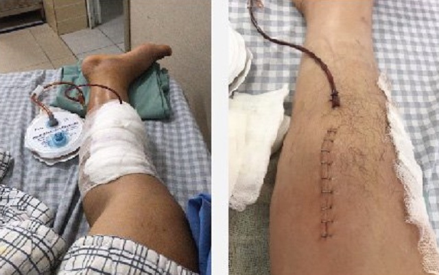 Người đàn ông 32 tuổi suýt mất chân vì sai lầm nhiều người Việt mắc phải - Ảnh 2.
