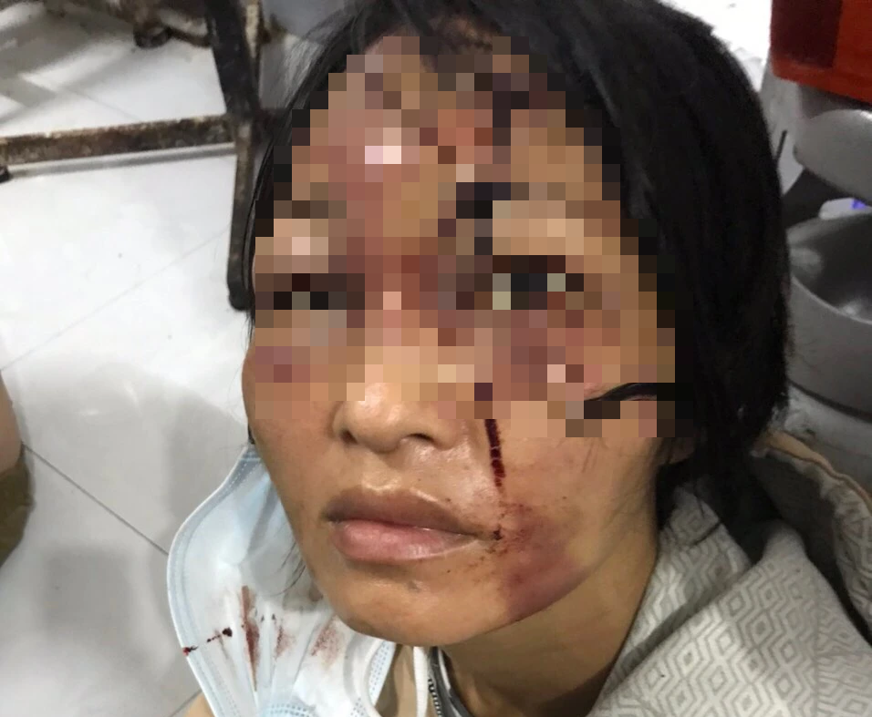 Đánh đập &quot;vợ hờ&quot; tàn bạo, một thanh niên ở An Giang bị bắt về tội bạo hành - Ảnh 2.