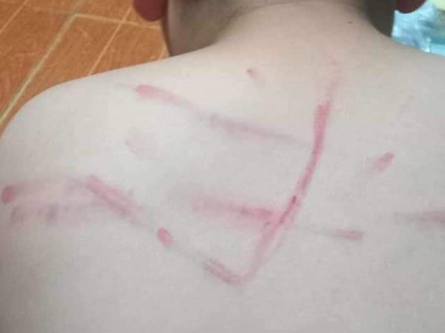Thanh Hóa: Không làm bài tập học sinh bị cô giáo đánh bầm tím lưng  - Ảnh 1.