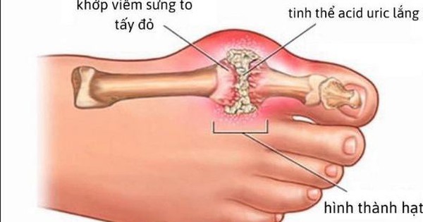 Phòng bệnh gout tái phát bằng món ăn bài thuốc đơn giản tại nhà