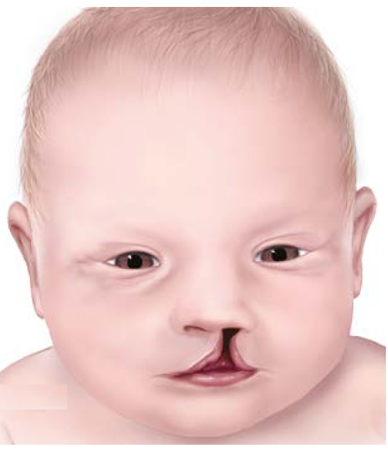 Dị tật bẩm sinh sứt môi - hở hàm ếch xảy ra ở giai đoạn nào của thai kỳ?- Ảnh 1.