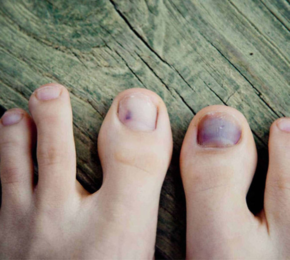 5 điều khác lạ ở chân có thể là tín hiệu cảnh báo mỡ máu cao- Ảnh 2.