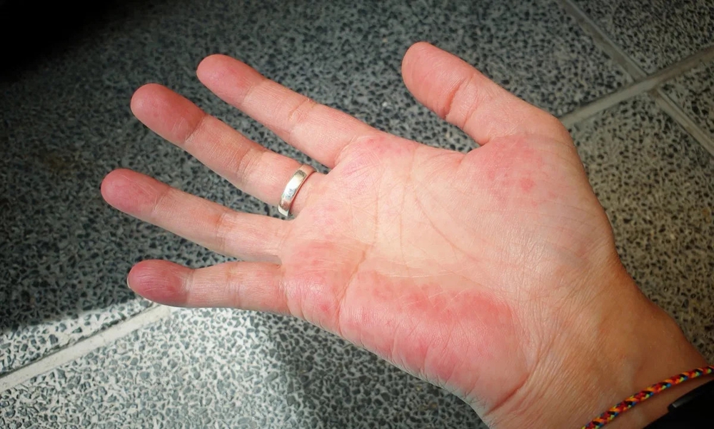 Bàn tay có thể dự báo bệnh tật: 4 dấu hiệu bất thường ở tay cảnh báo tim, gan suy yếu, ung thư ‘tìm đến’ - Ảnh 3.
