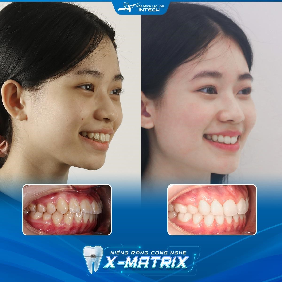Các chiến lược mới trong việc giảm thiểu biến chứng niềng răng - Ảnh 3.