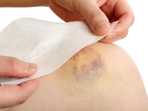 Xuất hiện vết bầm tím trên da, rất có thể bạn đang mắc bệnh này, đây là dấu hiệu cần được khám sớm - Ảnh 2.