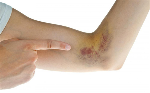 Xuất hiện vết bầm tím trên da, rất có thể bạn đang mắc bệnh này, đây là dấu hiệu cần được khám sớm - Ảnh 1.