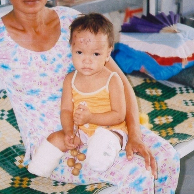 Cuộc sống hiện tại của bé gái gốc Việt bị bố mẹ nổ bom mất 2 chân: 20 năm sau được truyền thông thế giới gọi là 'nữ kình ngư thần kỳ' - Ảnh 1.
