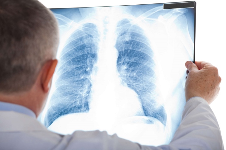 Những ai nên tầm soát ung thư phổi? - Ảnh 1.