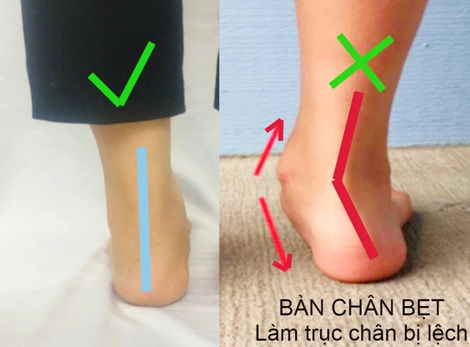 Một dấu hiệu ở bàn chân của con cảnh báo mắc phải dị tật mà 25% trẻ mắc phải - Ảnh 1.