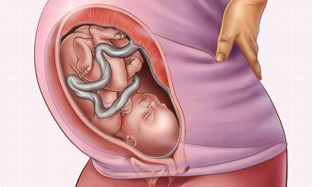 Từ trường hợp bé 1 tuổi mang bào thai trong não, hiện tượng thai trong thai được lý giải theo y học hiện đại - Ảnh 4.