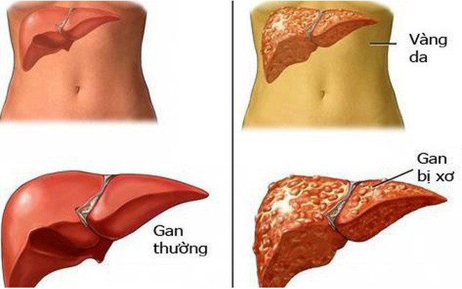 Cơ thể có 1 trong 7 dấu hiệu này chứng tỏ gan của bạn đang "kêu cứu"