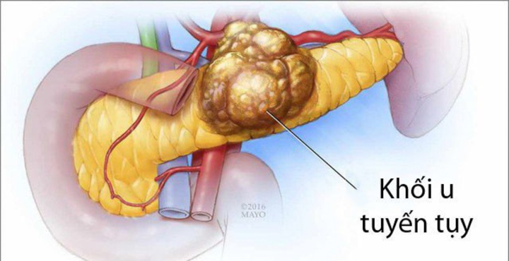 Triệu chứng ung thư tuyến tụy giai đoạn đầu - Ảnh 3.