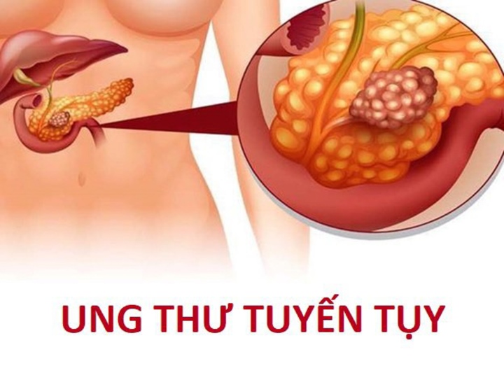 Triệu chứng ung thư tuyến tụy giai đoạn đầu - Ảnh 1.