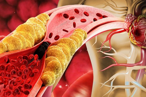 4 nhóm người mạch máu dễ bị lão hóa, muốn sống thọ hãy bổ sung thường xuyên 5 thực phẩm rẻ tiền, dễ kiếm này vào thực đơn - Ảnh 2.