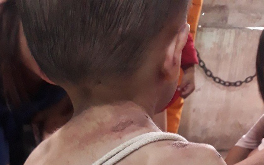 Vụ bé trai nghi bị bạo hành: Nạn nhân đa chấn thương, xuất huyết não