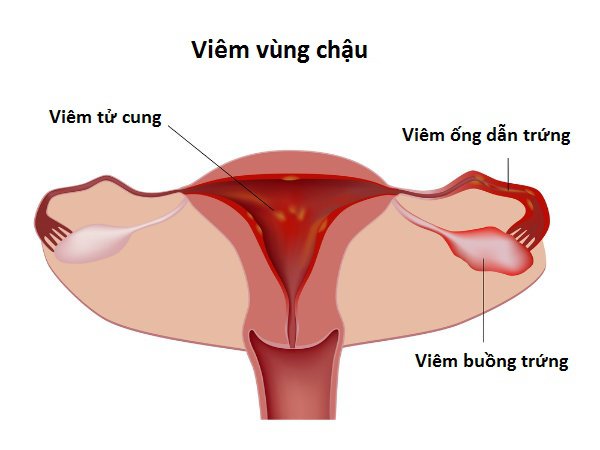 Biến chứng khi nhiễm nấm Chlamydia khi mang thai nguy hiểm thế nào? - Ảnh 2.