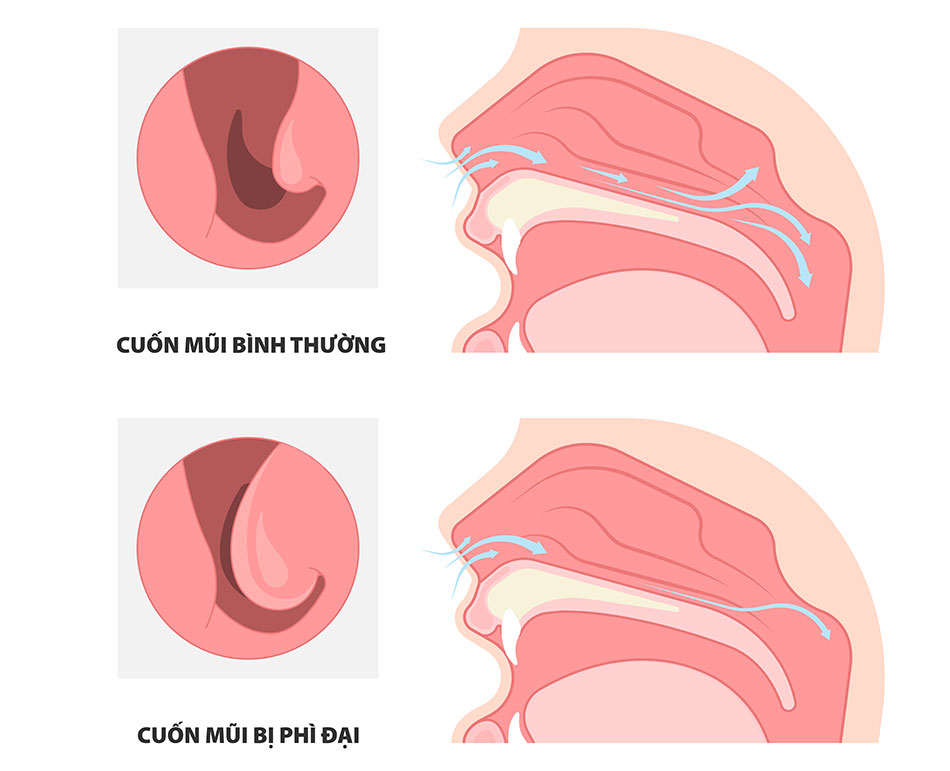 Ngạt mũi liên tục gây khó thở, khó ngủ do nguyên nhân gì và cách điều trị  - Ảnh 1.