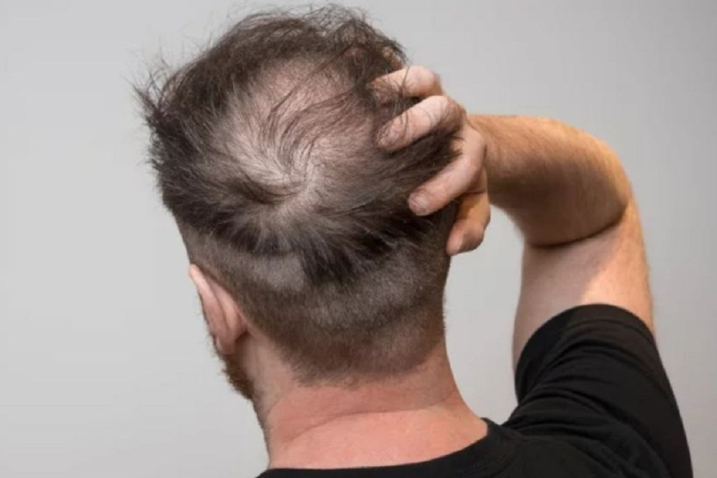 Đi khám vì tóc rụng, người đàn ông bất ngờ phát hiện mắc giang mai - Ảnh 1.