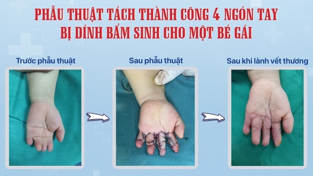 Bệnh viện Sản Nhi Nghệ An phẫu thuật tách thành công 4 ngón tay bị dính bẩm sinh cho trẻ - Ảnh 1.