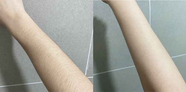 Bật mí phương pháp triệt lông tại nhà không gây mẩn đỏ, đau rát cho hội chị em - Ảnh 5. Bật mí phương pháp triệt lông tại nhà không gây mẩn đỏ, đau rát cho hội chị em - Ảnh 5.
