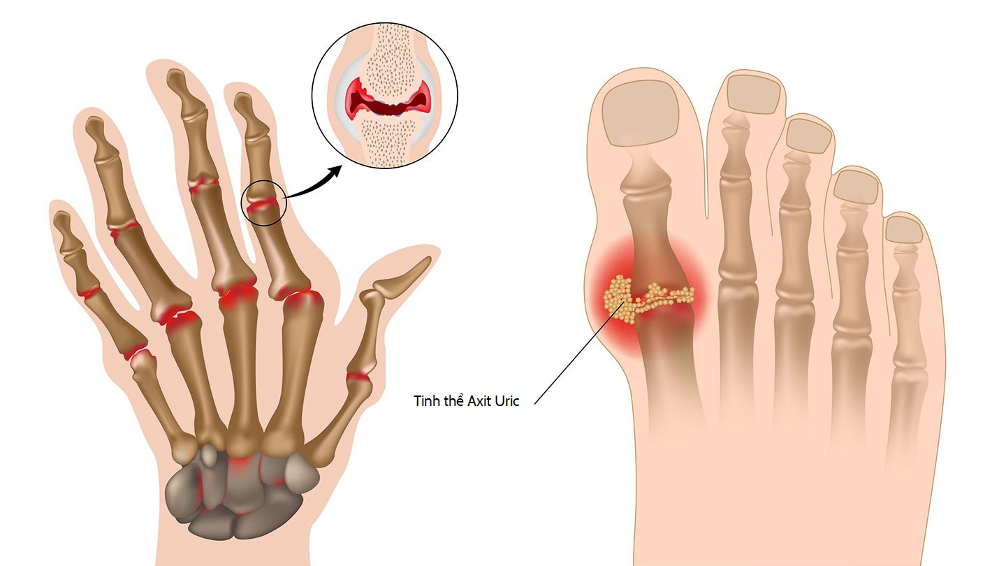 Người mắc bệnh gout có phải kiêng ăn trứng không? - Ảnh 2.