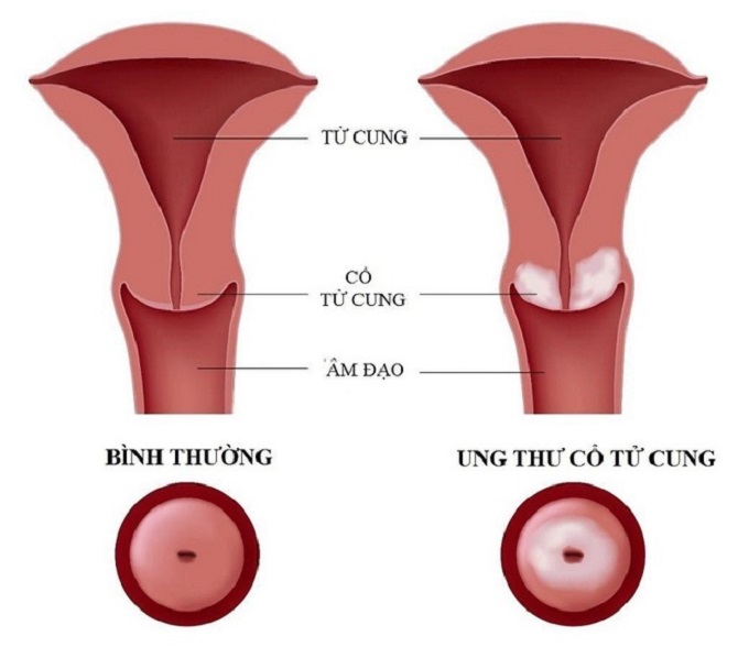 Cổ tử cung quan trọng thế nào trong hệ thống sinh sản của phụ nữ? - Ảnh 2.