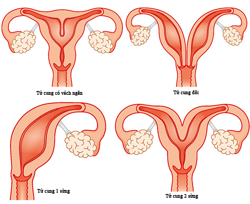 Bất thường ở tử cung ảnh hưởng đến khả năng sinh sản thế nào? - Ảnh 2.