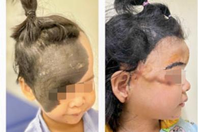 Căn bệnh rất hiếm gặp khiến cô bé có làn "da trâu" phủ nửa mặt