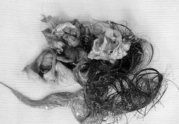 Cô gái 19 tuổi mang khối u quái chứa đầy tóc, da và xương  - Ảnh 2.