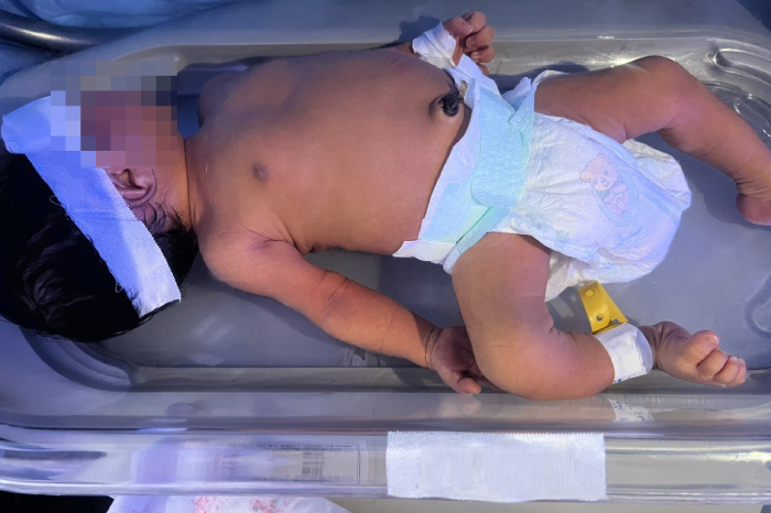 Bất đồng nhóm máu với mẹ, bé sơ sinh bị biến chứng nặng - Ảnh 1.