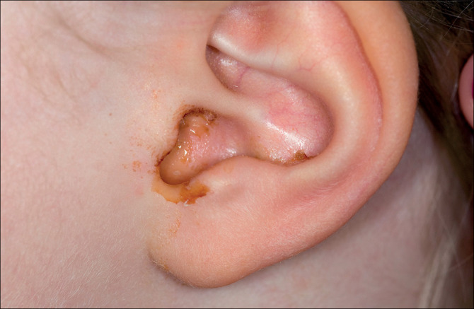 Viêm tai giữa cấp: Triệu chứng và phương pháp điều trị - Ảnh 2.