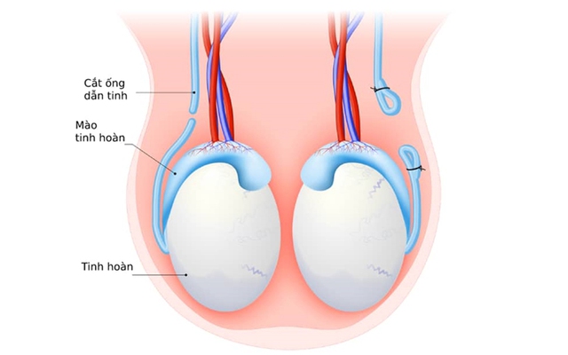 Thắt ống dẫn tinh có thể cải thiện đời sống tình dục của bạn theo 3 cách - Ảnh 2.
