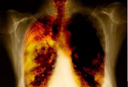 Vụ 4 công nhân tử vong do bụi phổi ở Nghệ An, biểu hiện và phòng ngừa bệnh bụi phổi như nào? - Ảnh 2.