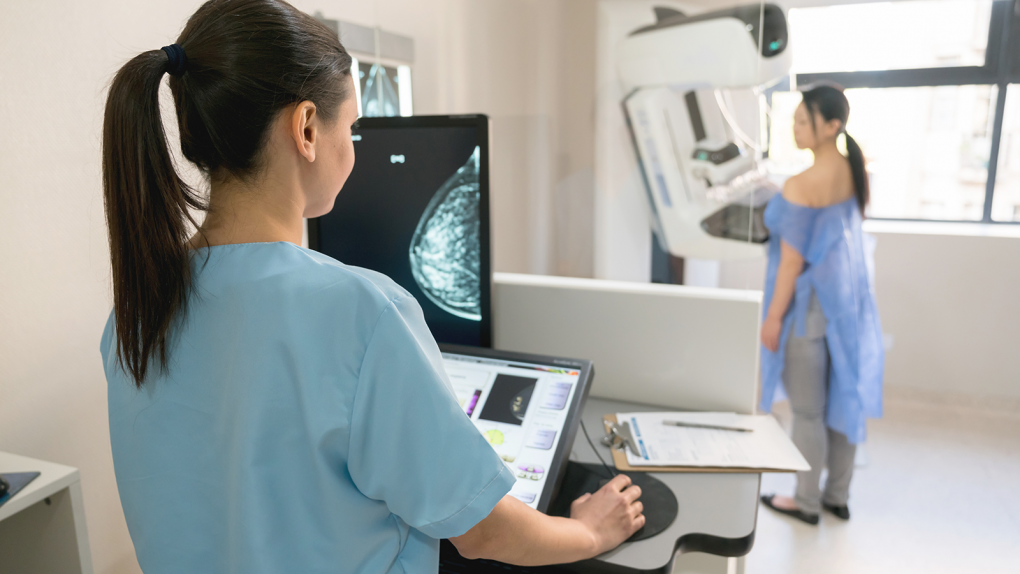Phụ nữ độ tuổi nào nên tầm soát ung thư và chụp quang tuyến vú để phát hiện sớm ung thư vú? - Ảnh 3.