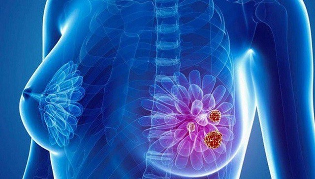 Bất ngờ nguyên nhân gây ung thư vú cao gấp 5 lần ở phụ nữ, chị em muốn ngừa bệnh nhất định phải biết điều này! - Ảnh 2.